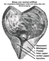 BPH mit Einengung der Urethra