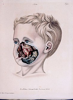 Resultado de imagen de estomatitis gangrenosa