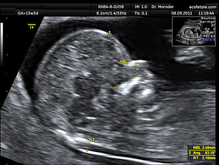 <span class="mw-page-title-main">Nuchal scan</span> Routine ultrasound done between 11 and 14 weeks pregnancy