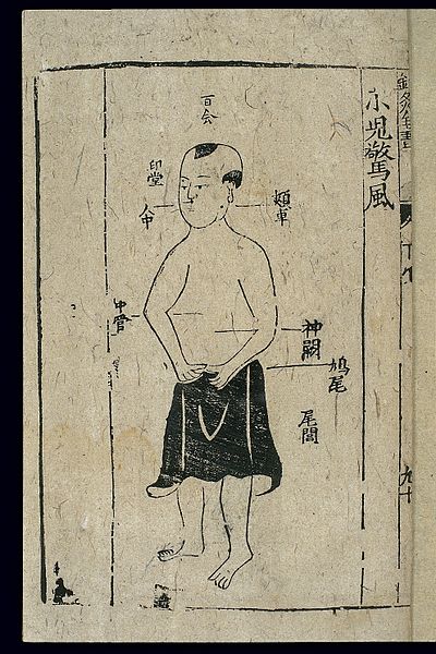 File:Paediatric acu-moxa; infantile convulsions, Chinese woodcut Wellcome L0037842.jpg