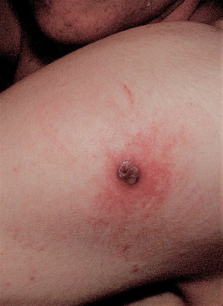 File:Smallpox vaccine site.jpg