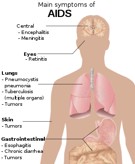 Een diagram van een menselijke torso met daarop de meest voorkomende symptomen van aids