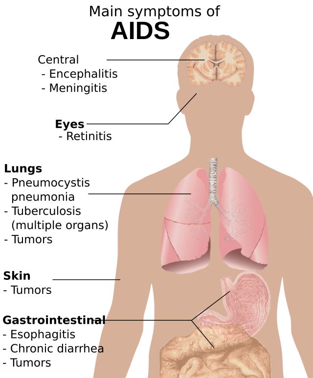 The image illustrates effects of AIDS in the brains, eyes, lungs, skin, and gastrointestinal system.