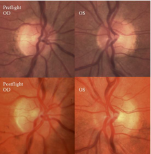 Figure 13: Fundus examination of the sixth case of visual changes from long-duration spaceflight. Preflight images of normal optic disc. Postflight right and left optic disc showing grade 1 (superior and nasal) edema at the right optic disc. VIIP Figure 13.png