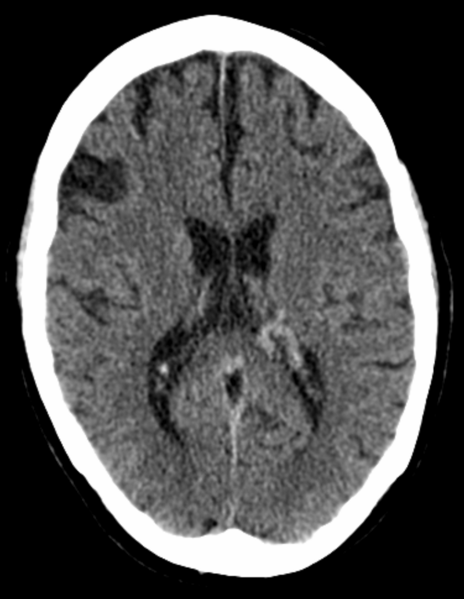 File:001 Arteriovenous Malformation CT axial 02.png