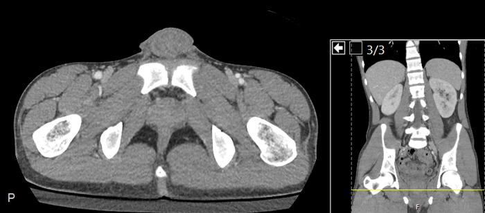 CT of a normal abdomen and pelvis, axial plane 276.png