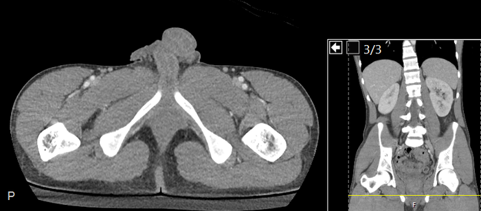 CT of a normal abdomen and pelvis, axial plane 290.png
