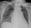 Chest radiograph of miliary tuberculosis 1.jpg