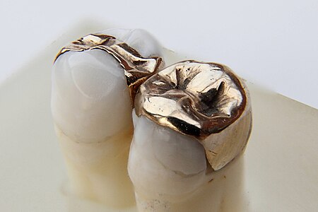 Fail:Dental inlays Gold Focus stacking with freeware CombineZP 12 03.jpg