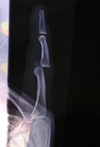 Рендген снимак ишчашења левог кажипрста