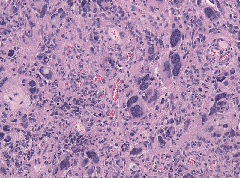 File:Glioblastoma anaplastic cells HE.jpg