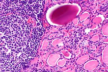 High powered magnification showing lymphocytic infiltration of the thyroid gland in autoimmune thyroiditis Hashimoto thyroiditis -- high mag.jpg