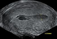 Hematometra