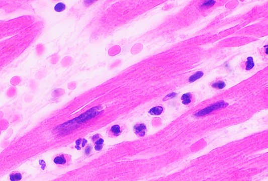 Neutrophils are seen in a myocardial infarction at approximately 12–24 hours,[59] as seen in this micrograph.