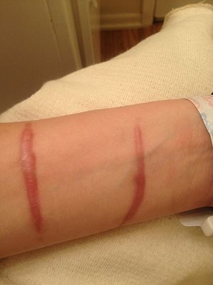 Hypertrophic scar -4 months after incident- 2013-04-05 00-46.jpg