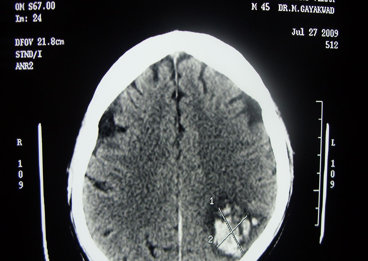 Hemorrhagia cerebral - Wikipedia bahasa Indonesia 