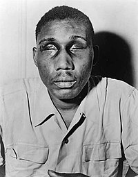 Isaac Woodard, a World War II veteran, after having his eyes gouged out by a police officer in Batesburg-Leesville Isaac-Woodard-1946.jpg