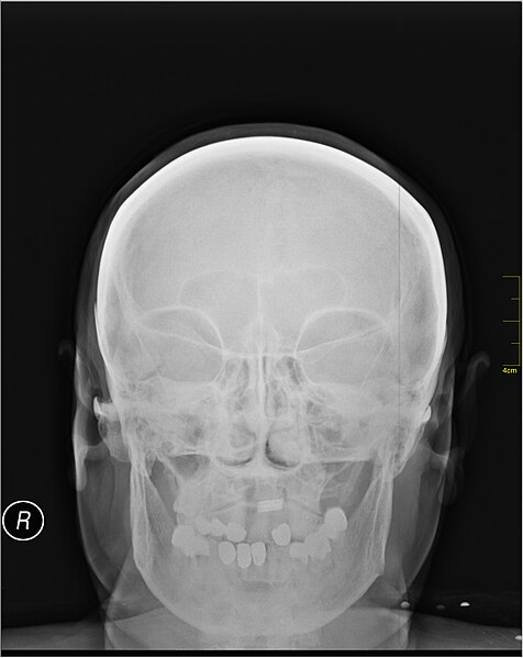 File:Medical X-Ray imaging OZN06 nevit.jpg