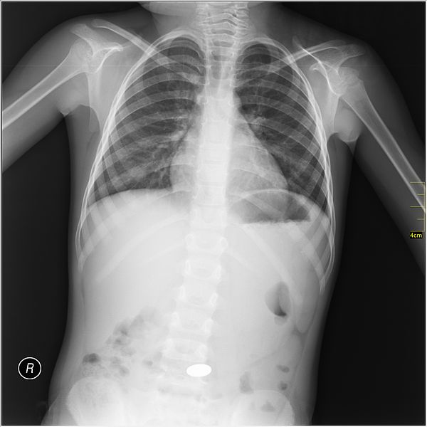 File:Medical X-Ray imaging WPT07 nevit.jpg