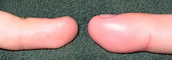 Left and right ring fingers of the same individual. The distal phalanx of the finger on the right exhibits edema due to acute paronychia.