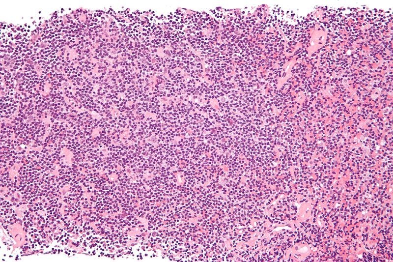 File:Nodular lymphocyte predominant Hodgkin lymphoma - high mag.jpg