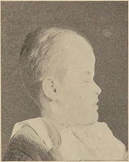 Oxycephaly in hydrocephalus