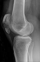 Transverse fracture of patella