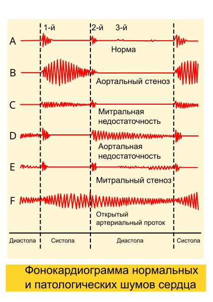 File:Phonocardiograms from normal and abnormal heart sounds-ru.svg