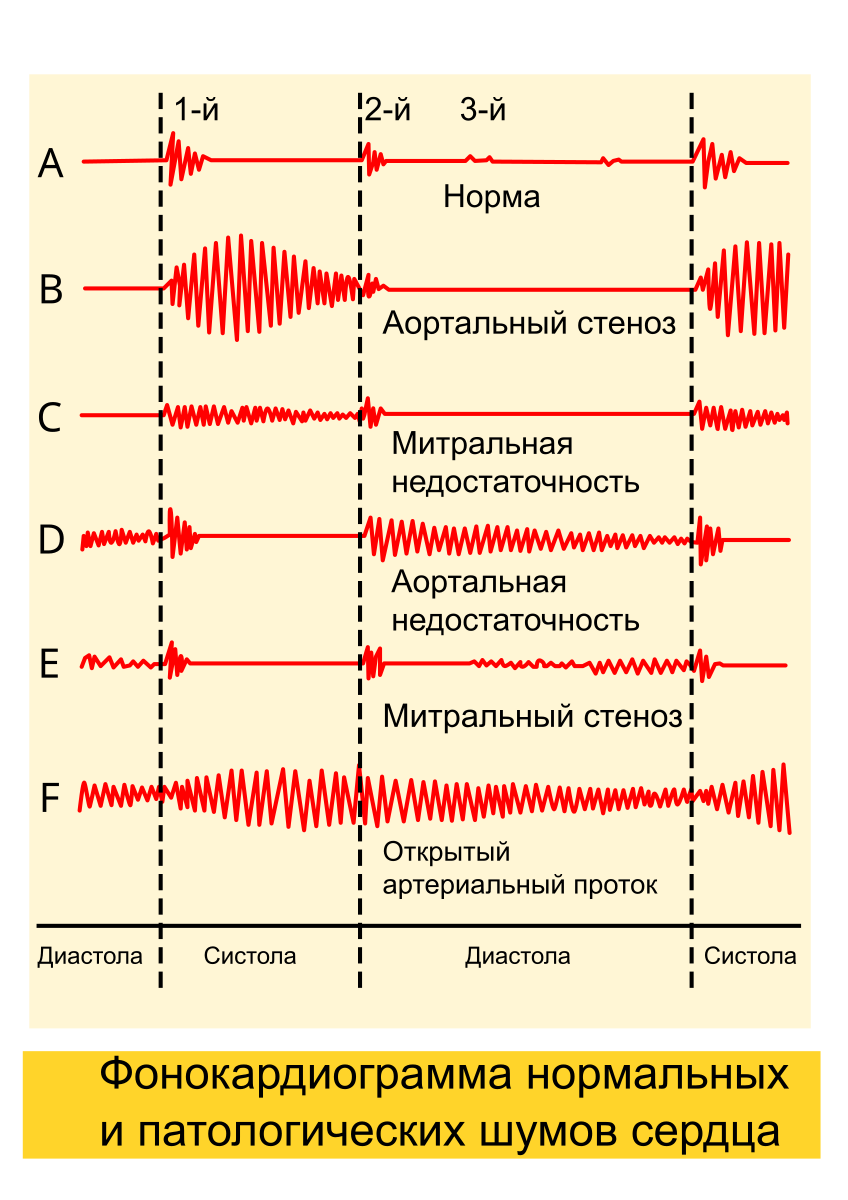 Шум при митральной недостаточности