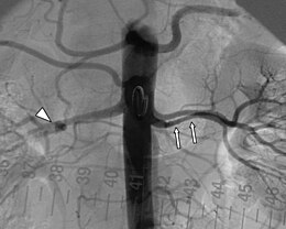 Renal artery angiography in a patient with fibromuscular dysplasia (1).jpg