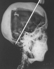 Una radiografia del cranio di Tutankhamon; la freccia indica una possibile causa di morte