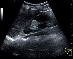 Angiomyolipoma seen as a hyperechoic mass in the upper pole of an adult kidney on renal ultrasonography.