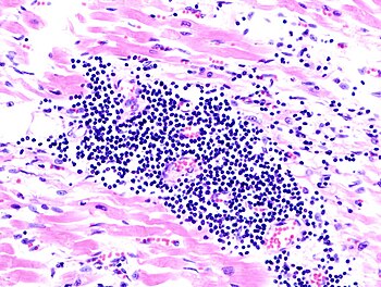 Histologic slide demonstrating viral myocarditis, an infection of the heart muscle Viral myocarditis (1).JPG