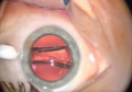 Augenoperation-implantierbare-kontaktlinse-06.png