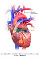 Coronary artery bypass graft, single bypass