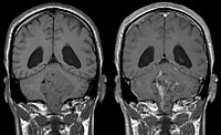 Ependymoma of 4.ventricle in MRI. Left without, right with contrast-enhancement.