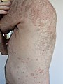 The rash of guttate psoriasis on a 66-year-old male
