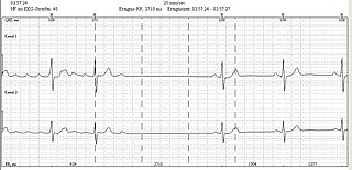 Holter AtrialFlutter.jpg