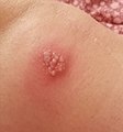 Immagine di un herpes simplex sul ginocchio.jpg