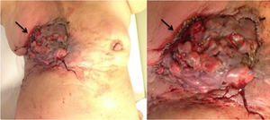 A case of human breast myiasis initiated by the Australian sheep blowfly (Lucila cuprina). Lucilia cuprina - A case of human breast myiasis - 01.png