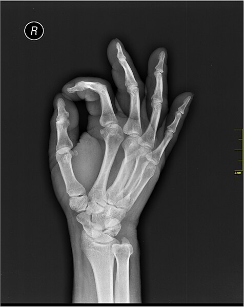 File:Medical X-Ray imaging TJE07 nevit.jpg