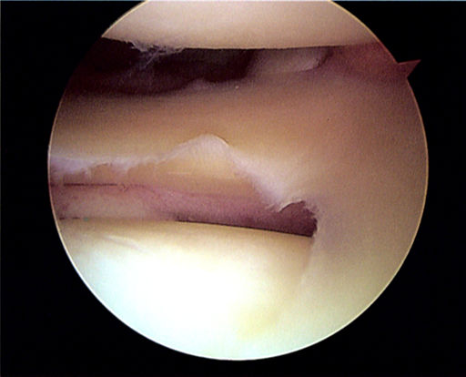 Meniscus tear 2010 - closeup