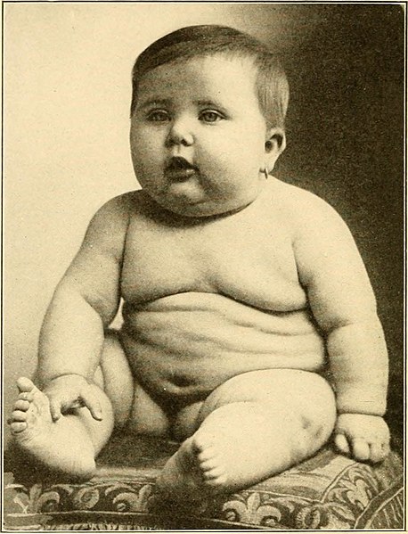 File:Modern diagnosis and treatment of diseases of childern; a treatise on the medical and surgical diseases of infancy anf childhood (1911) (14595074530).jpg