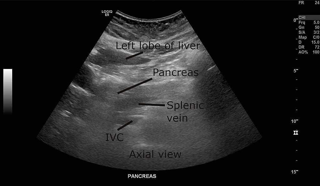 pancreas ultrasound