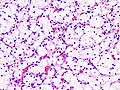 Carcinome rénal à cellules claires. Grade de Führman 1. HE, x400.