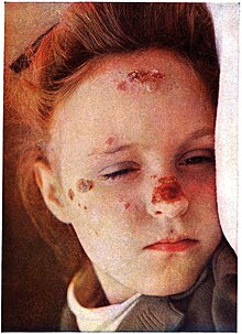 Polymorphous light eruptions on the face of a 6-year-old girl, with scarring from past eruptions Sequeira Plate 6.jpg