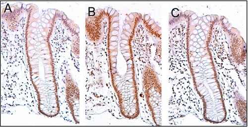 Sequential sections of the same colon crypt with immunohistochemical staining (brown) showing normal high expression of DNA repair proteins PMS2 (A), ERCC1 (B) and ERCC4 (XPF) (C). This crypt is from the biopsy of a 58-year-old male patient who never had colonic neoplasia and the crypt has high expression of these DNA repair proteins in absorptive cell nuclei throughout most of the crypt. Note that PMS2 and ERCC4 (XPF) expression (in panels A and C) are each reduced or absent in the nuclei of cells at the top of the crypt and within the surface of the colonic lumen between crypts. Original image, also in a publication. Sequential sections of a colon crypt showing normal high expression of PMS2 (A), ERCC1 (B) and ERCC4 (C).tiff