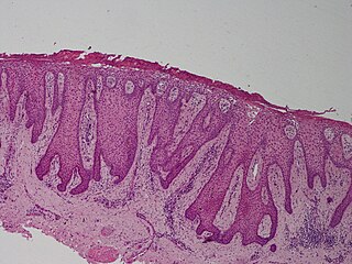 <span class="mw-page-title-main">Clear cell acanthoma</span> Medical condition