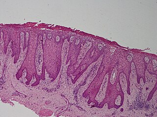 Clear cell acanthoma