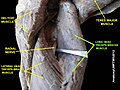 Long head triceps brachii muscle (shown in green text)